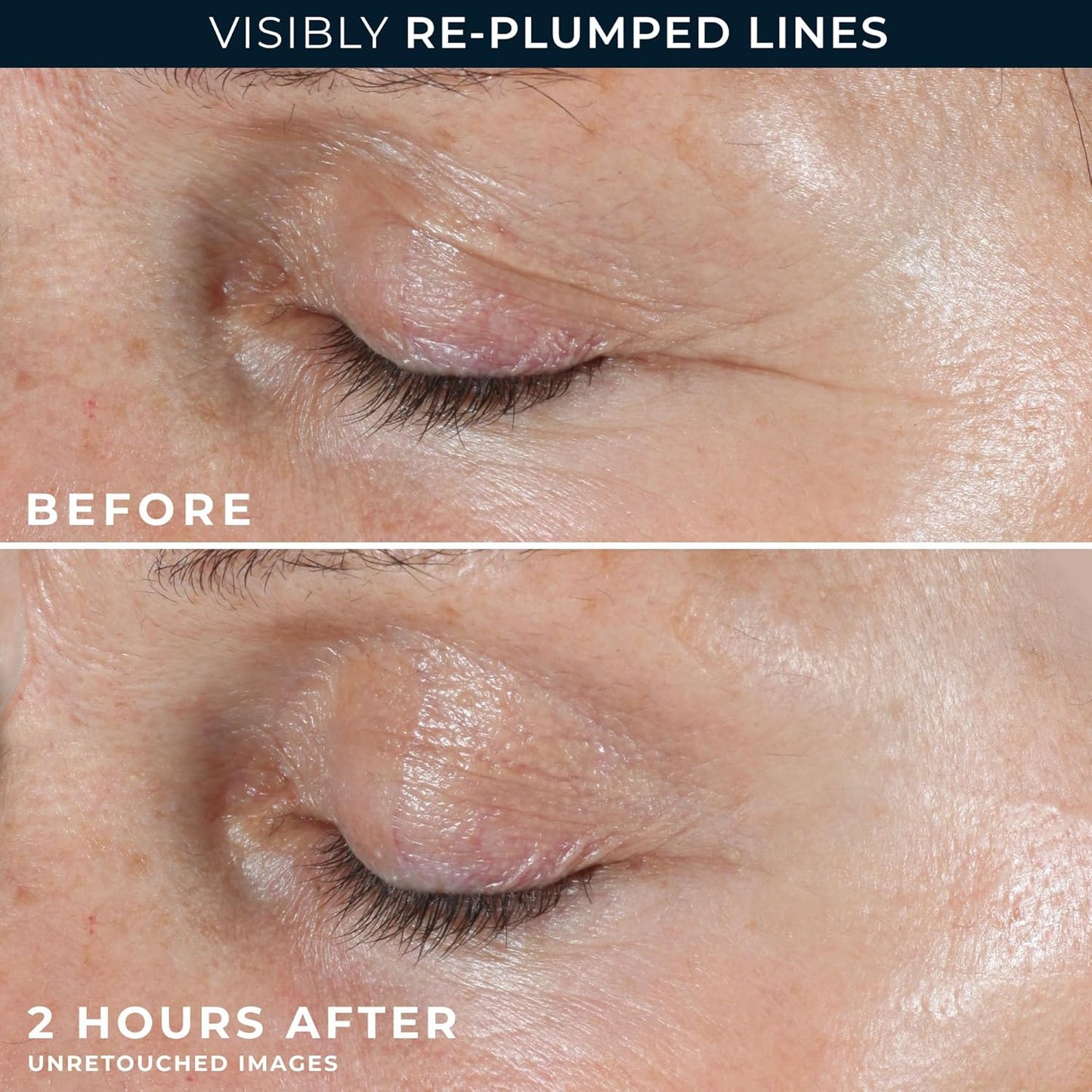 Korean Micro-needling Eye Patches